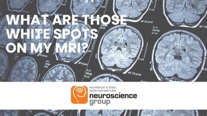 What are bright white spots on MRI?