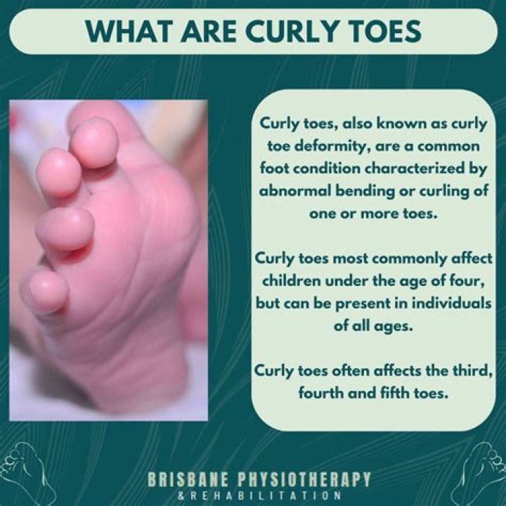 What are curly toes?