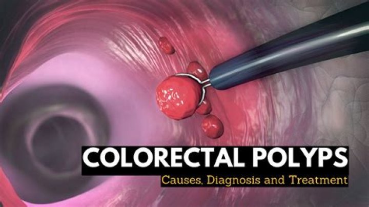 What are polyps caused from?
