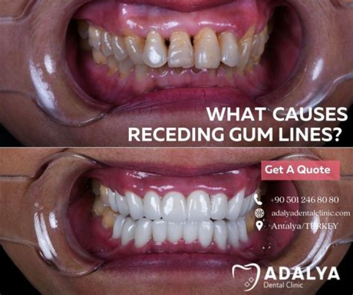 What are receding lines?