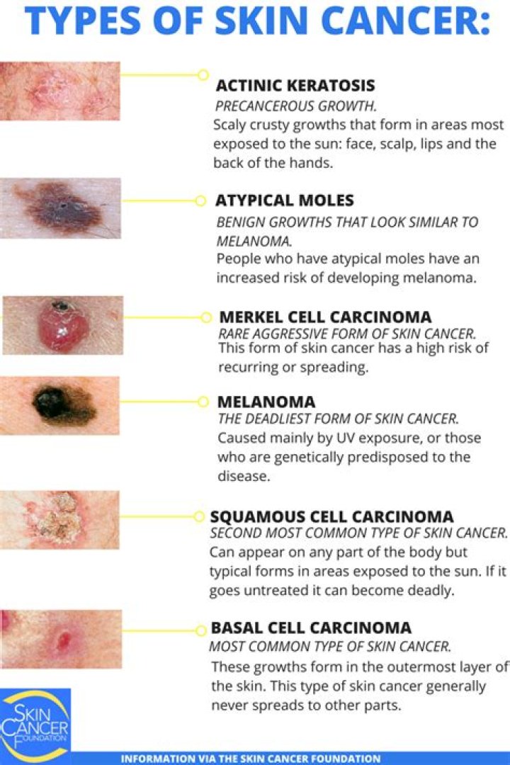 What are the 4 types of skin?