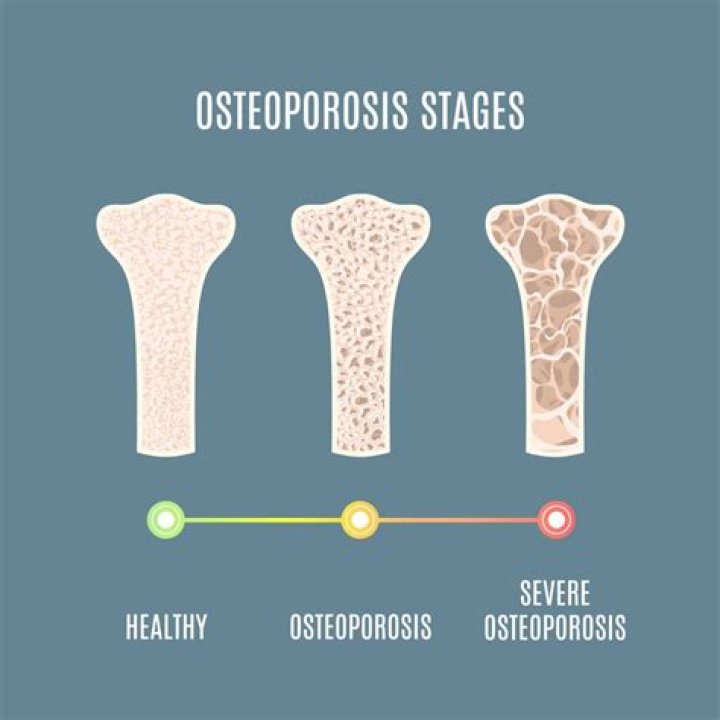 What are the three stages of osteoporosis?