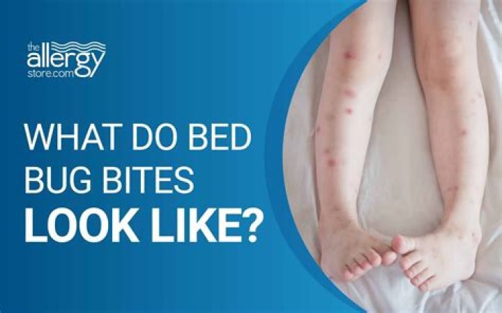 What bites resemble bed bug bites?