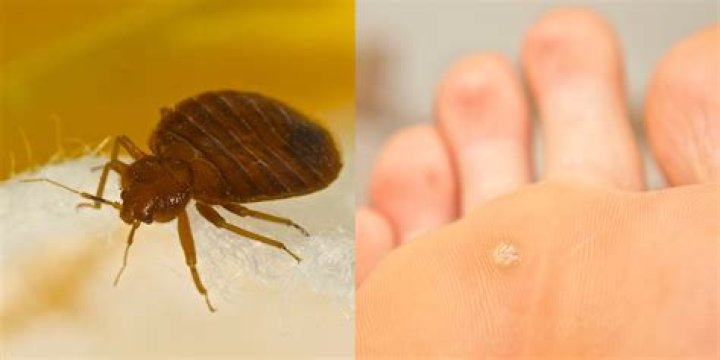 What bugs burrow in your skin?