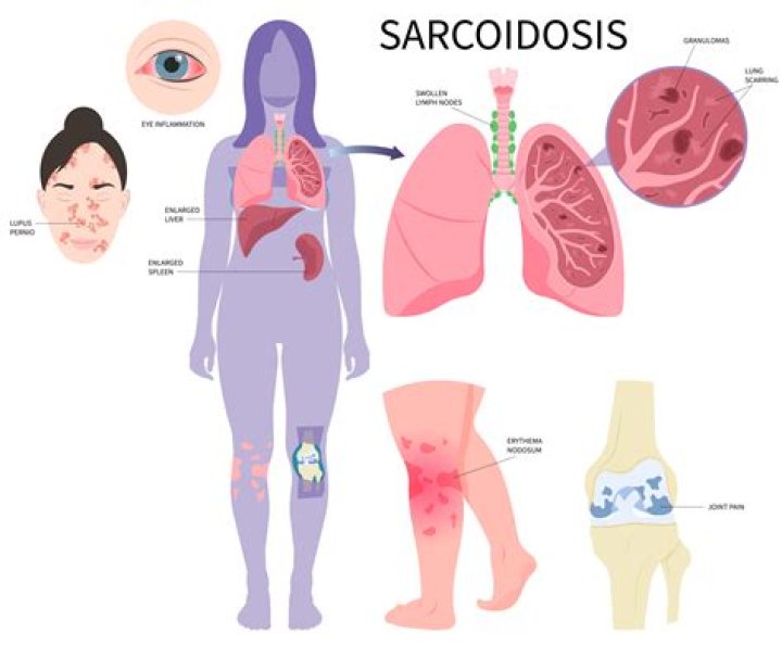 What can be mistaken for sarcoidosis?