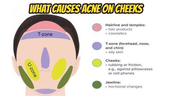 What causes acne on chin?