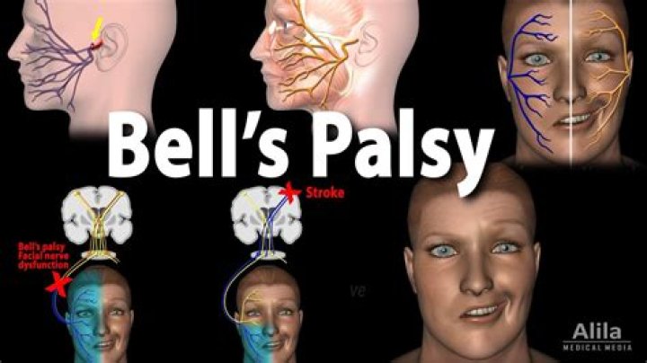 What causes Bell's palsy to flare up?