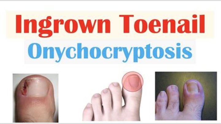 What causes double toenail growth?