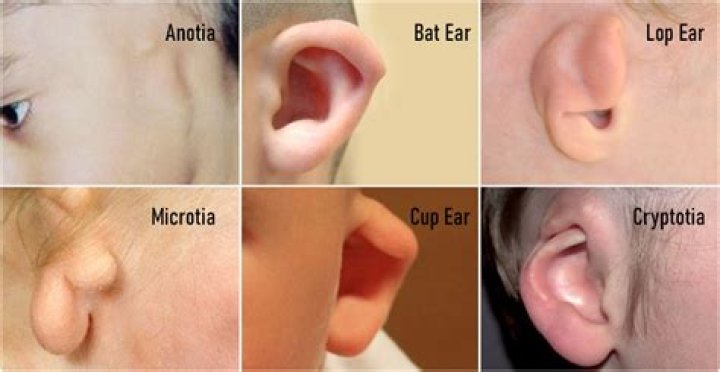 What causes elf ears?