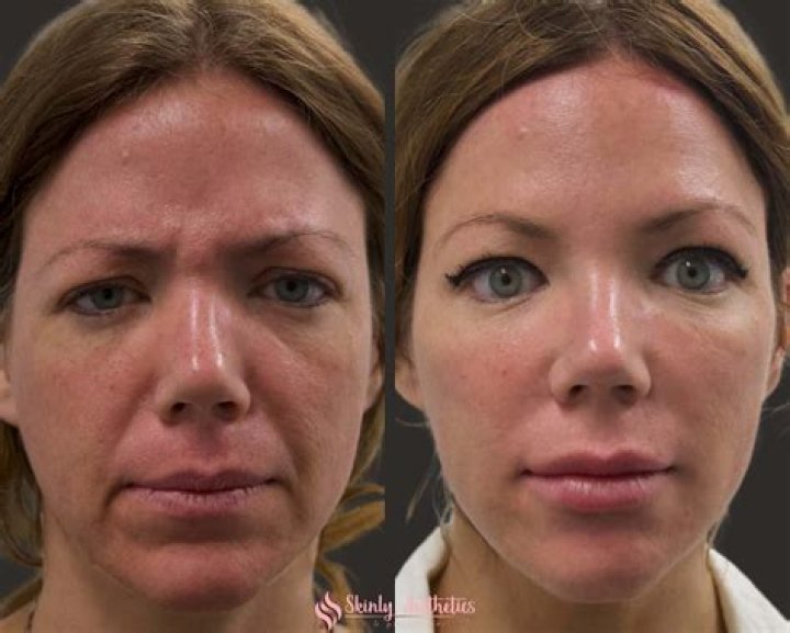 What causes loss of volume in face?