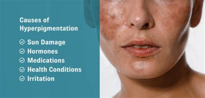 What causes pigmentation on face?