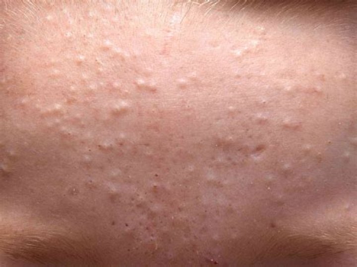 What causes tiny bumps on face?