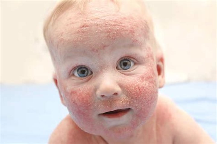 What celebrities have eczema?