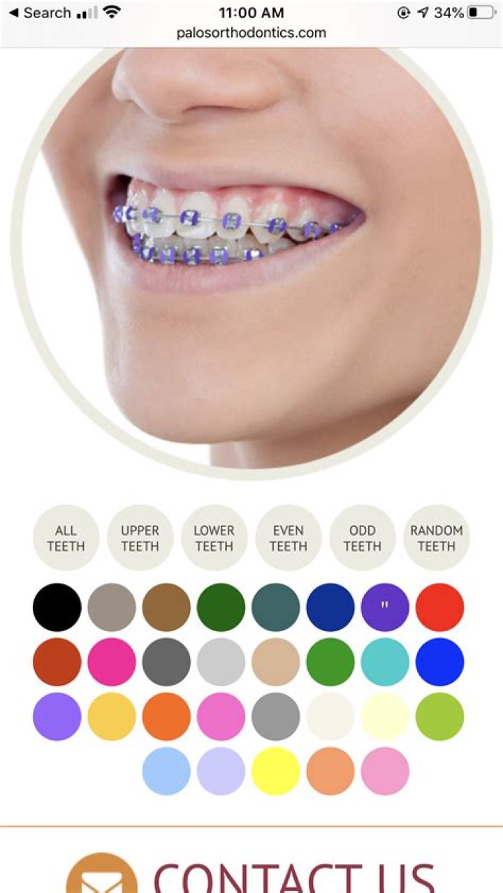 What color braces are most popular?
