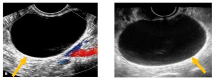 What color is a cyst on an ultrasound?