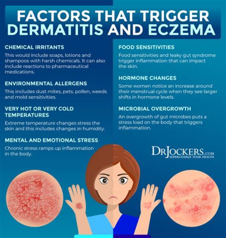 What could trigger eczema?