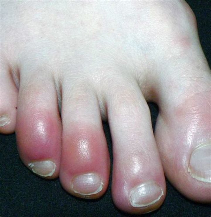 What do red toes mean?