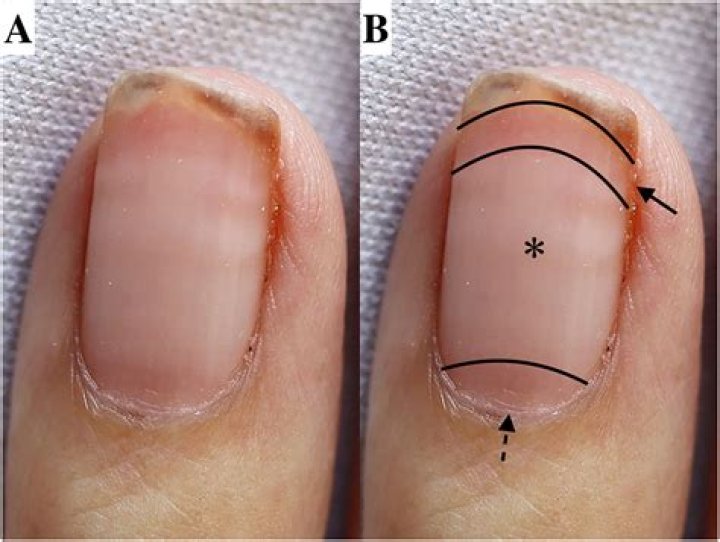 What do small nail beds mean?