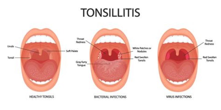 What do tonsils look like?