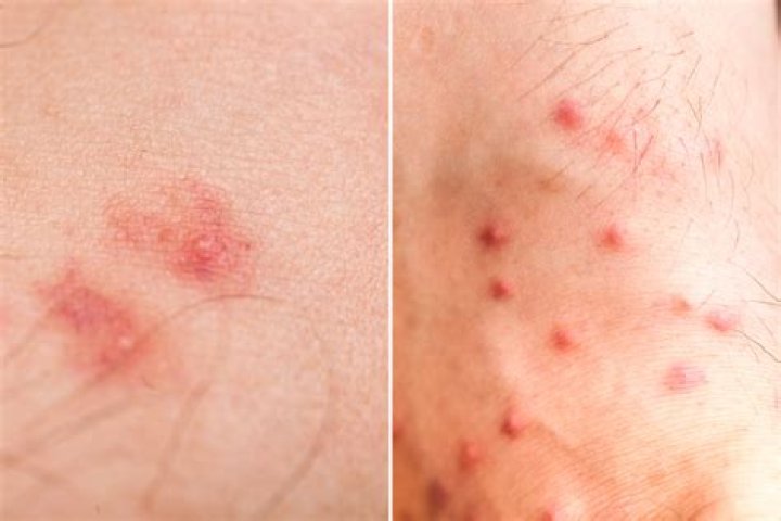 What does a flea bite look like?
