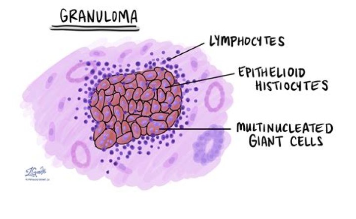 What does a granuloma look like?