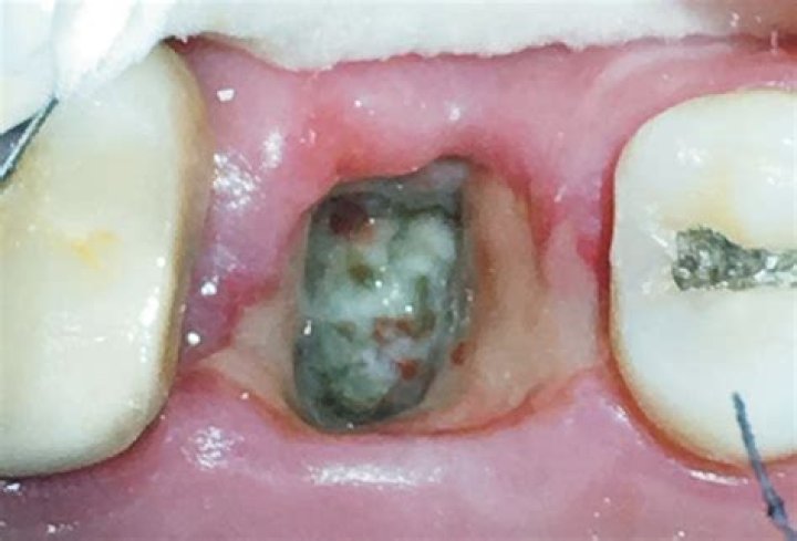 What does a healthy extraction site look like?