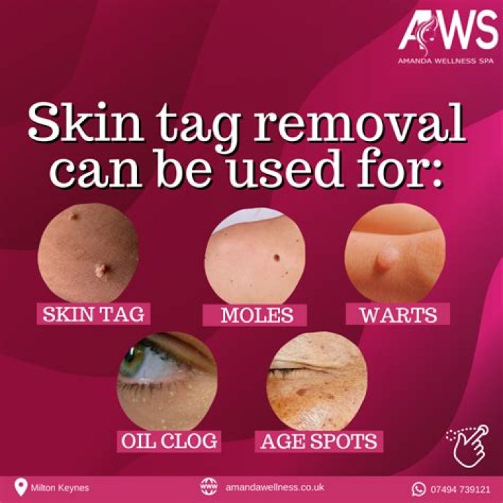 What does a large skin tag look like?