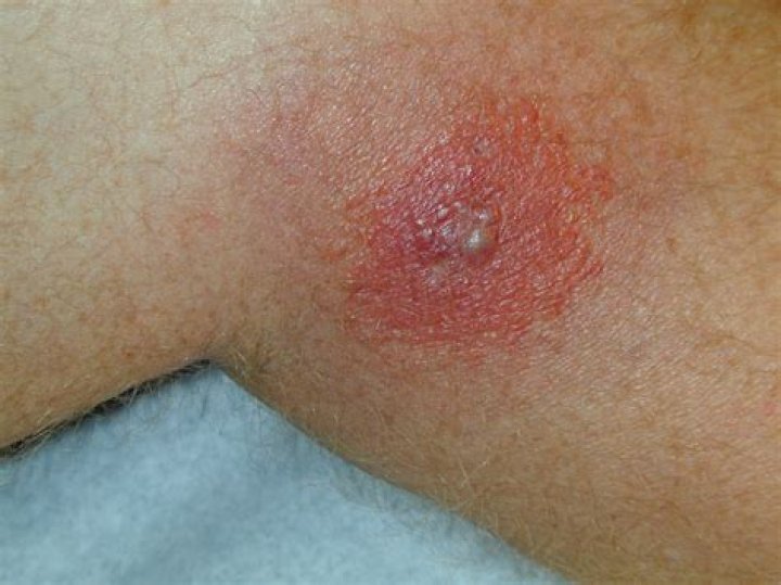 What does a normal tick bite look like?