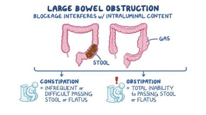 What does a partial bowel obstruction feel like?