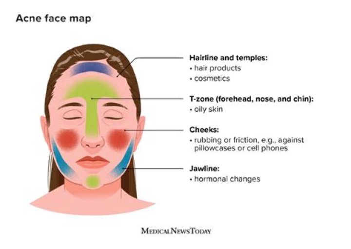 What does acne on chin mean?