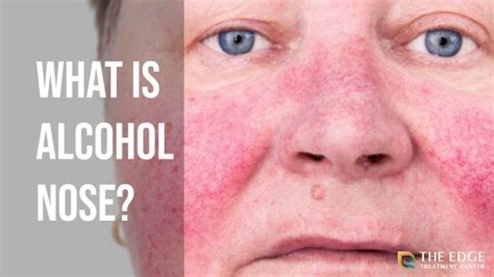What does an Alcoholics breath smell like?