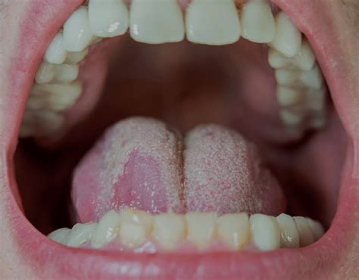 What does an infection in the mouth feel like?