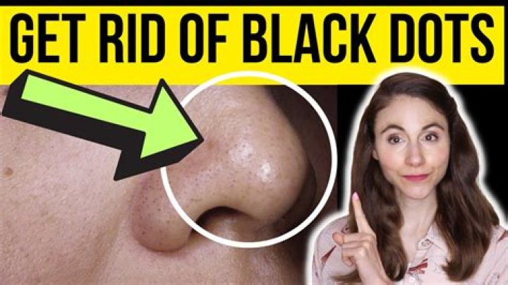 What does black dots in your iris mean?