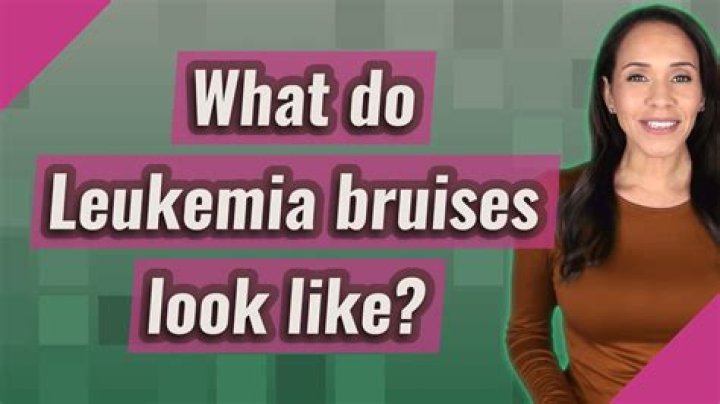 What does bruising from leukemia look like?