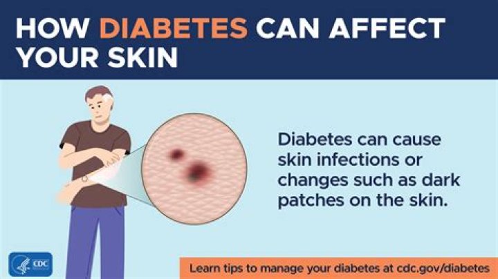 What does diabetes smell like?