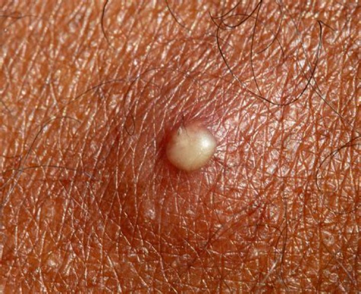 What does infected pus look like?