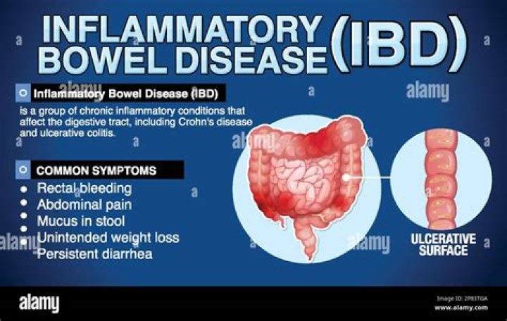 What does inflammation of the bowel feel like?