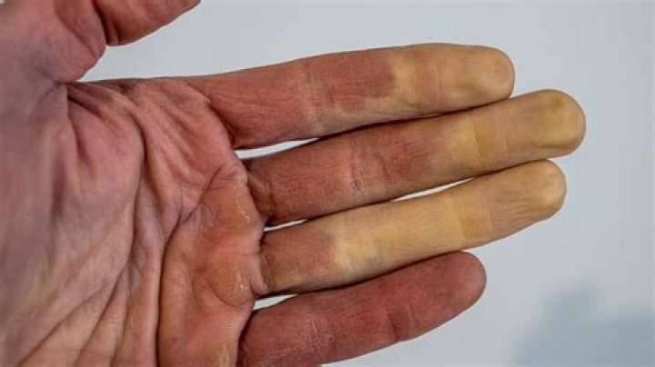 What does it mean when one finger turns blue?
