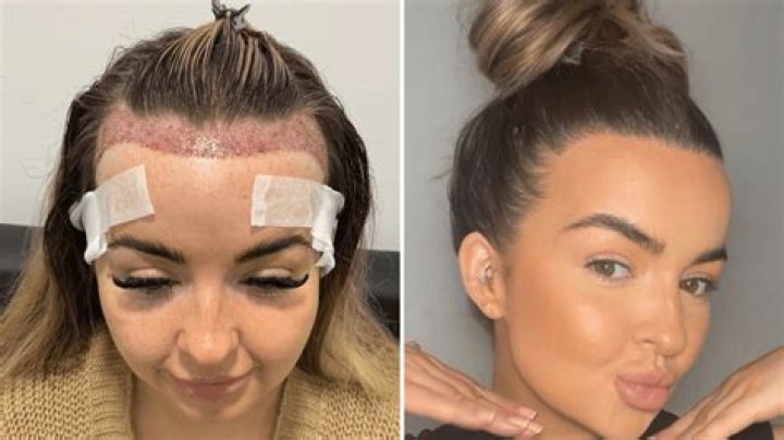 What does melted hairline mean?