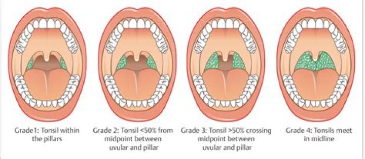 What does size 4 tonsils mean?