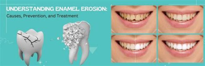 What does tooth enamel loss look like?