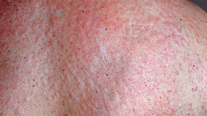 What does typhus rash look like?