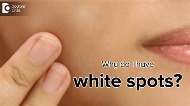 What does white skin around a wound mean?