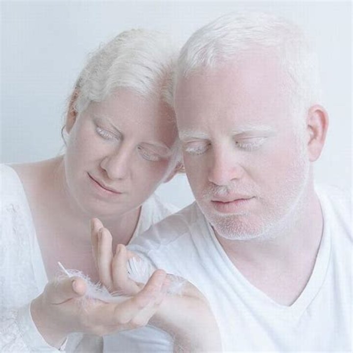 What gender is albinism most common in?