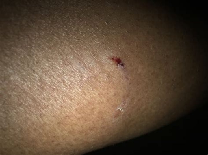 What happens if a dog teeth scratches you?