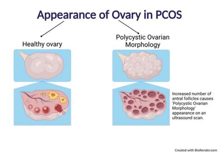 What happens when ovary is removed?