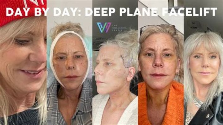 What is a plane facelift?