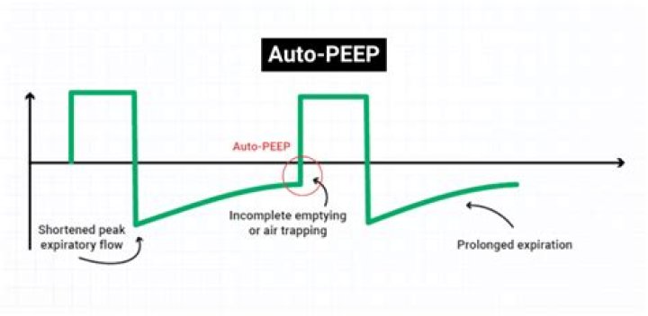 What is auto-PEEP?