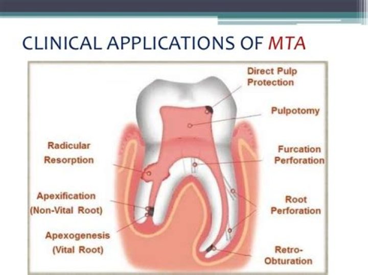 What is Biodentine used for?