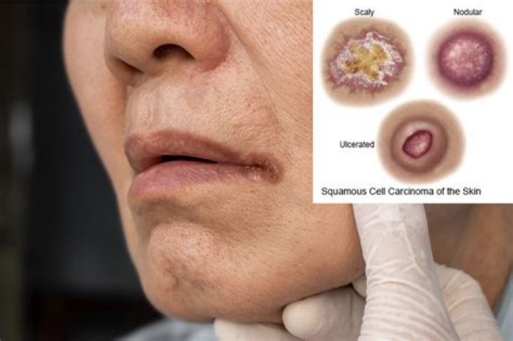What is considered early detection of squamous cell carcinoma?